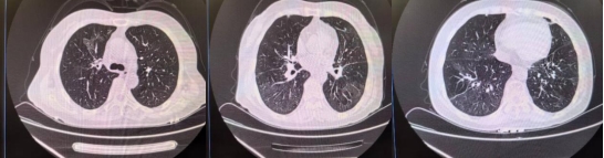 1个月后复查胸部CT