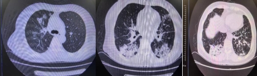 患者入院时胸部CT