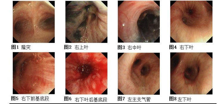 气管镜下表现1 气管镜下表现1