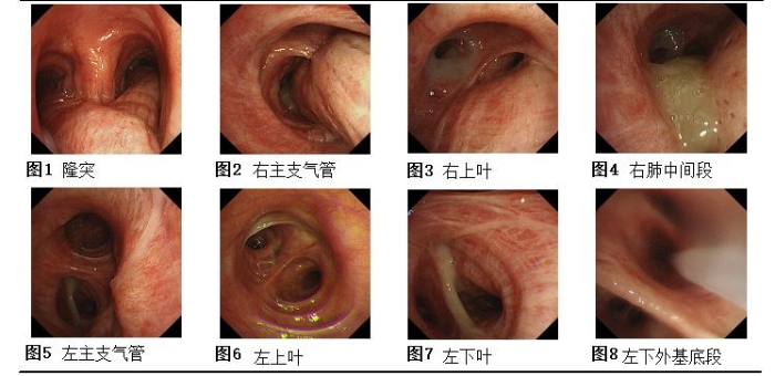 气管镜下表现2 气管镜下表现2
