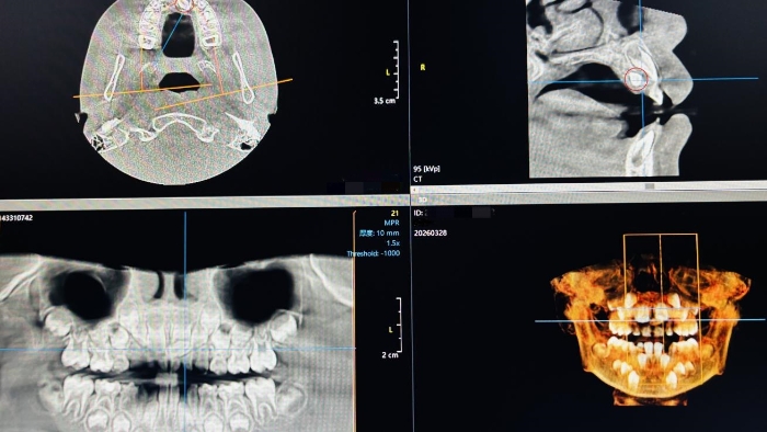 术前CBCT
