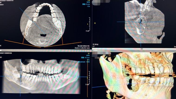 术前CBCT 术前CBCT